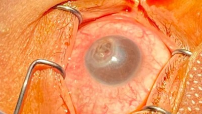 Image from case study_Ocular examination of patient with corneal melting