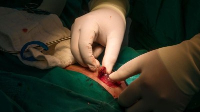 La chirurgie de shunt améliore la démarche chez les patients atteints d’hydrocéphalie à pression normale idiopathique