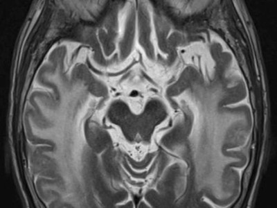 Positronenemissionstomographie zerebrale Amyloidablagerungen