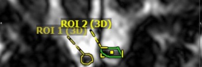 Volumetrie des Bulbus olfactorius