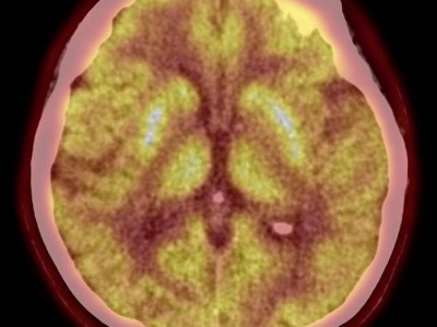 FDG-PET bei 72-jähriger Patientin: pathologischer Hypermetabolismus der Putamina beidseits