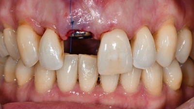 Zahn 11: Zustand nach Sofortimplantation und Bindegewebstransplantation. Zahnlücke mit eingebrachtem Implantat und vernähter Wunde