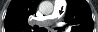 Zentrale Lungenembolie