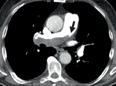 Zentrale Lungenembolie