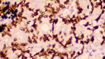 Histology of patient with thyroid carcinoma, parathyroid adenoma, and paraganglioma