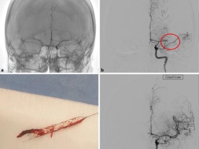 Thrombektomie mit Stent-Retriever