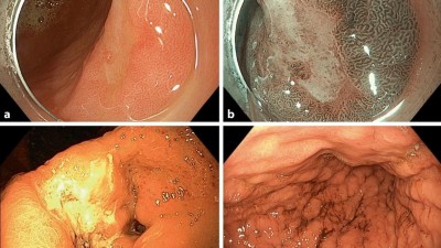 Endoskopische Befunde des Magenkarzinoms