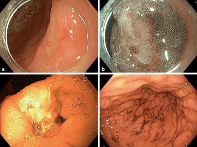 Endoskopische Befunde des Magenkarzinoms