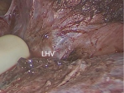 Kolorektale Lebermetastase in Segment II, nahe der linken Lebervene (LHV).