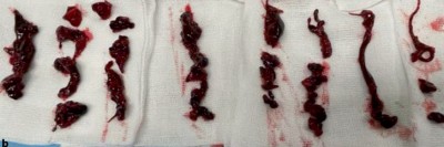 Kathetergestützte mechanische Thrombektomie 