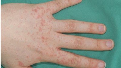 Penicillinallergie an der Hand