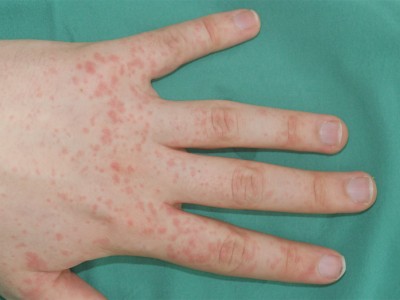 Penicillinallergie an der Hand