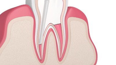 Illustration eines Zahns im Längsschnitt mit eingebrachter endodontischem Instrument