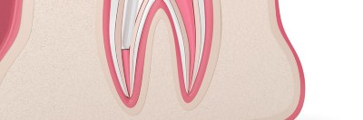 Illustration eines Zahns im Längsschnitt mit eingebrachter endodontischem Instrument