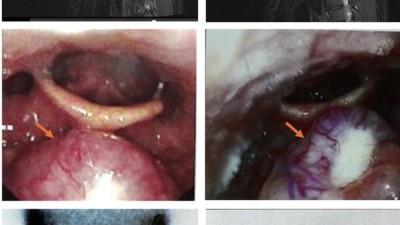 Imaging of ectopic lingual thyroid