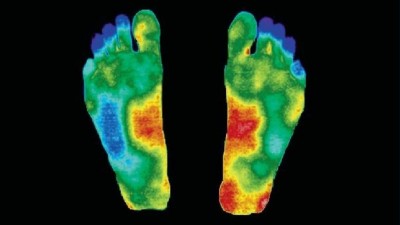 Thermal plantar foot images of a person with diabetes