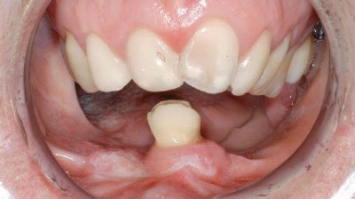 Frontale Ansicht des Gebisses einer Person mit Hanhart-Syndrom in Okklusion und stark reduzierter Bezahnung und reduziertem Kieferkamm im Unterkiefer