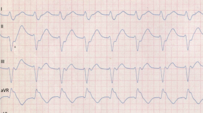Extremitäten-EKG-Ableitungen