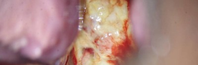 Glaszellentumor der Gebärmutter