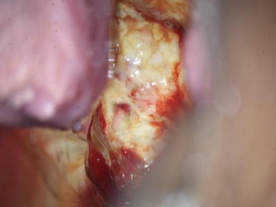 Glaszellentumor der Gebärmutter