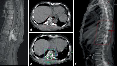 Initial potenziell instabile Läsion von BWK 10 bei Multiplem Myelom