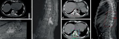 Initial potenziell instabile Läsion von BWK 10 bei Multiplem Myelom