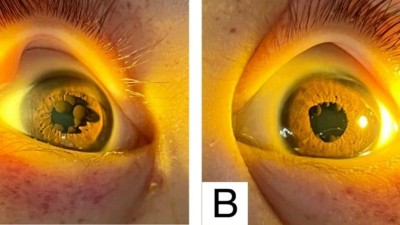 Image from case study_Iris pigment epithelial cysts in acute lymphoblastic leukemia