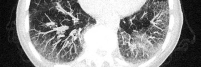 CT einer Lunge mit Milchglastrübungen