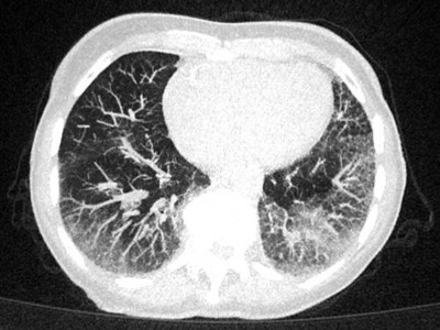 CT einer Lunge mit Milchglastrübungen