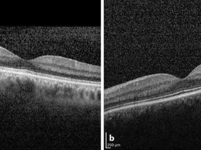 Verwaschene EZ-Zone bei Vit-A-Mangel