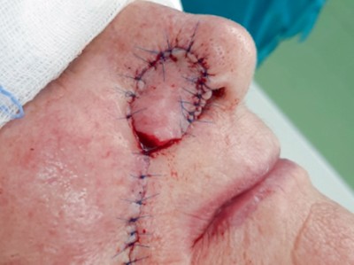 Insellappenplastik an der Nase