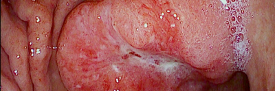 Endoskopisches Bild eines Magenkarzinoms