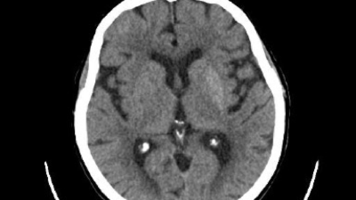 Hyperdense lesion in the left putamen