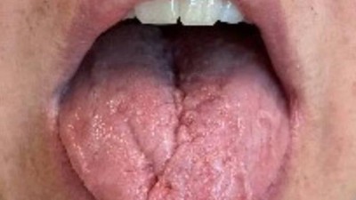 Geschwollene Zunge der Patientin