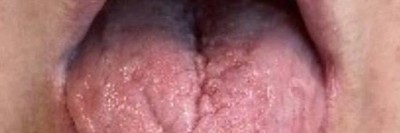 Geschwollene Zunge der Patientin