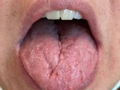 Geschwollene Zunge der Patientin