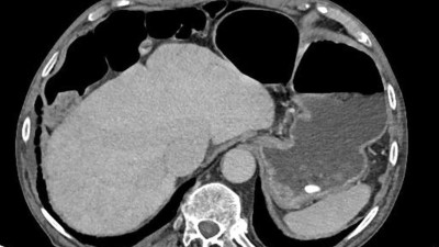 Chilaiditi-Syndrom in einer CT-Aufnahme