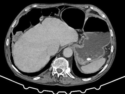 Chilaiditi-Syndrom in einer CT-Aufnahme