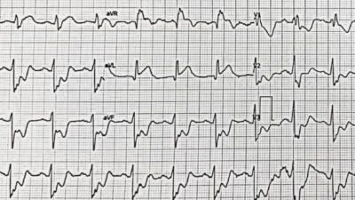 ECG of Acute Left Main Coronary Artery Occlusion in APS patient