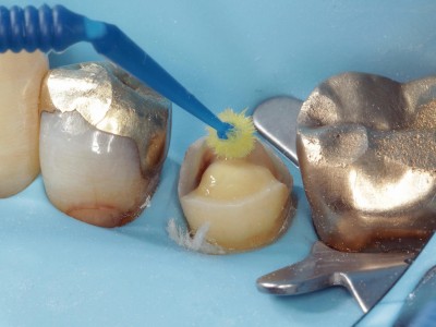 Mehrere Backenzähne, die durch einen Kofferdam umgeben sind. Es wird mit einem kleinen Bürstchen etwas auf den mittleren der zu sehenden Zähne aufgebracht.