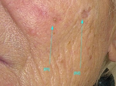 Hautveränderungen an der rechten Wange