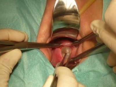 Notfallcerclage bei kurzer Zervix