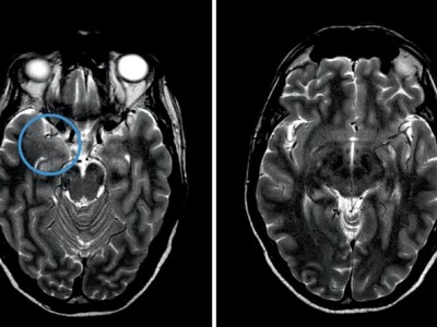 cMRT-T2w-Sequenzen: hippocampale Ödeme