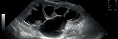 Sonographien Ureteropelviner Stenosen