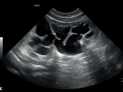 Sonographien Ureteropelviner Stenosen