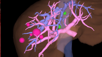 3D reconstruction of liver metastases from breast and colorectal cancer