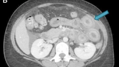 CT scan of patient with enteritis and peritonitis as first presentation of SLE