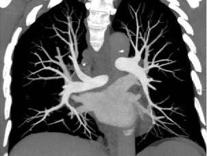 CT-Pulmonalisangiographie
