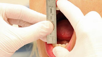 Bild eines offenen Mundes: Erfassung der Schneidekantendistanz bei maximaler aktiver Kieferöffnung mit einem Messinstrument