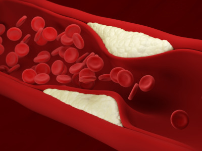 Plaque builds up inside an artery